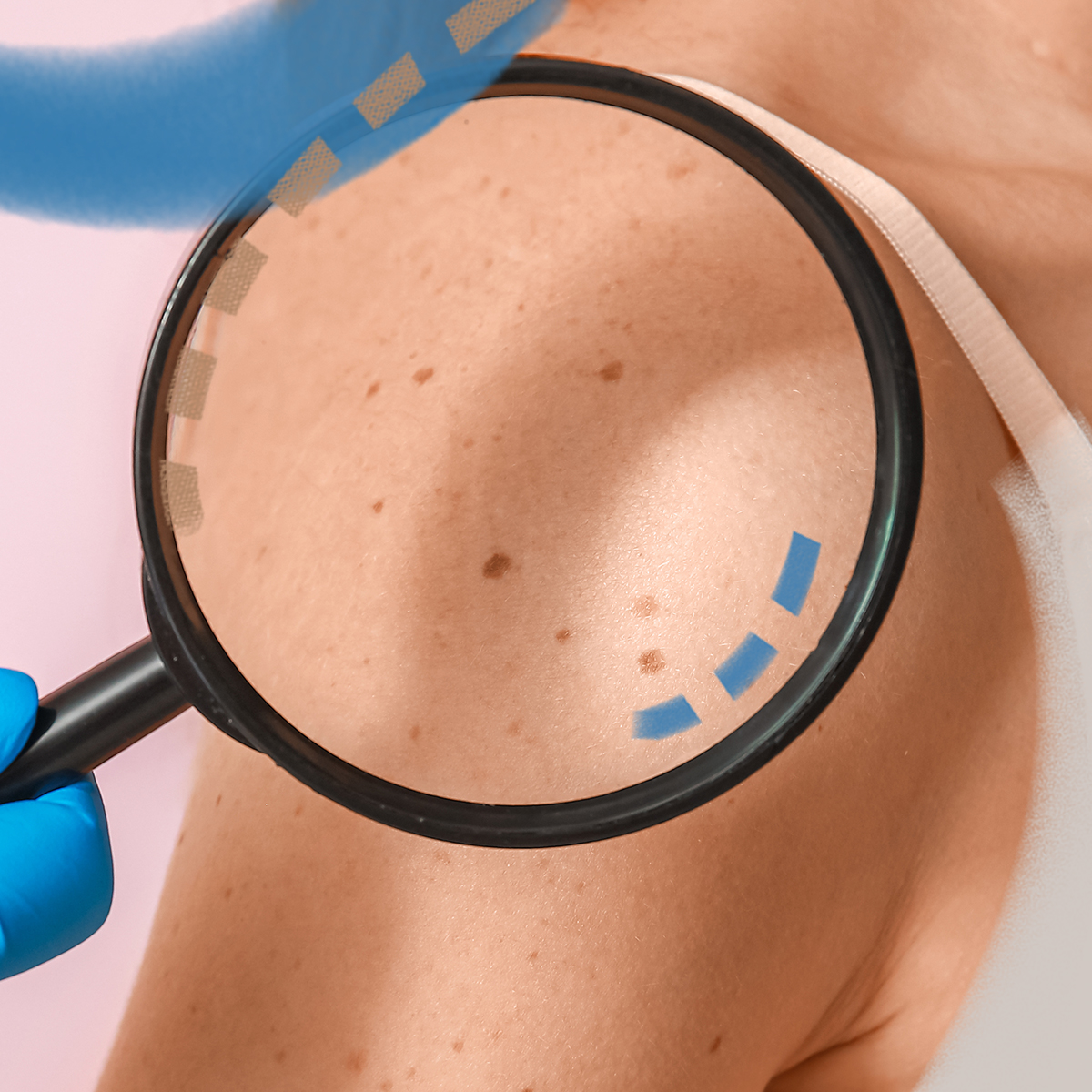 Odstranění kožních výrůstků a znamének Rychlé a bezpečné řešení. Svěřte se do péče odborníků Perfect Clinic · Dermatology.