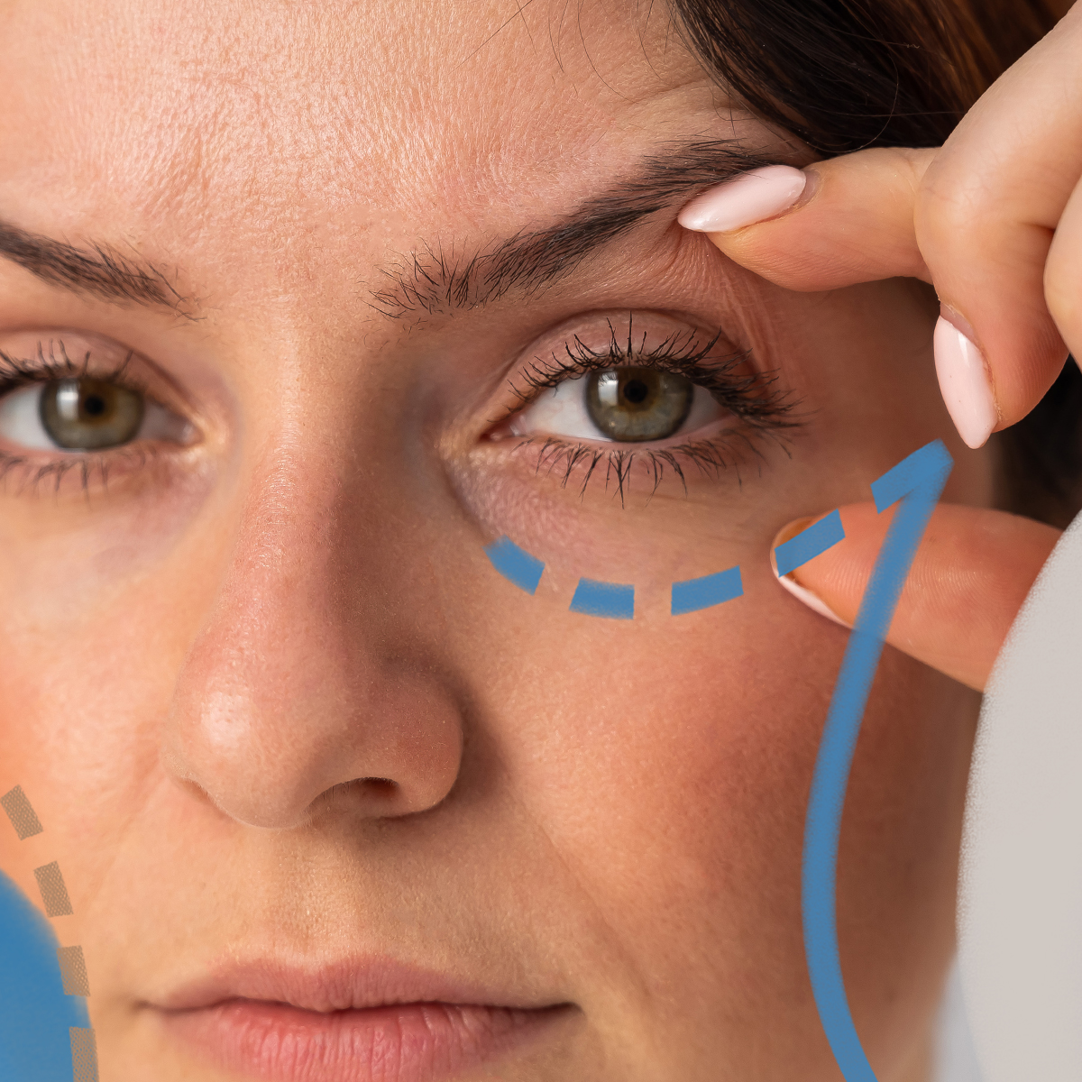 Operace horních víček