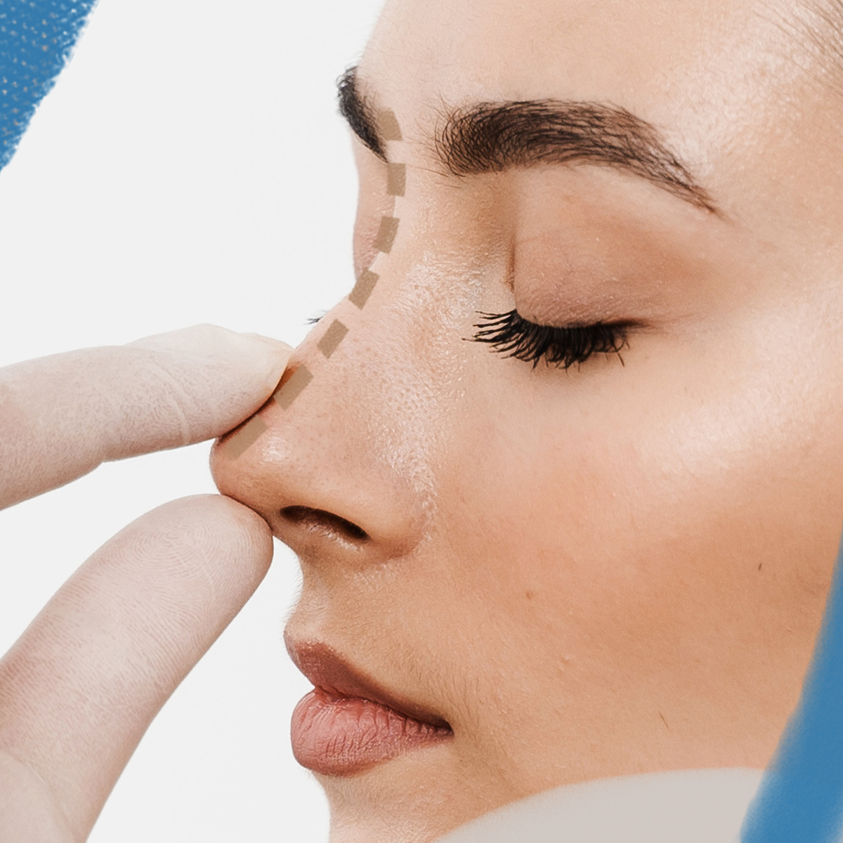 Operace hrotu nosu. Korekce špičky nosu v Perfect Clinic