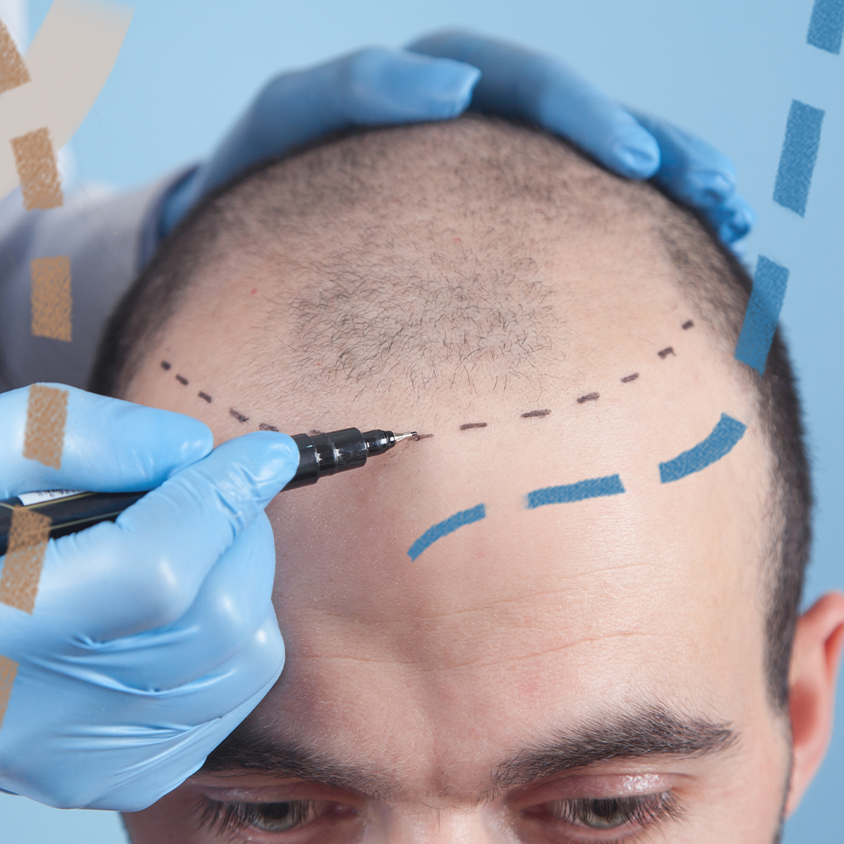 Transplantace vlasů