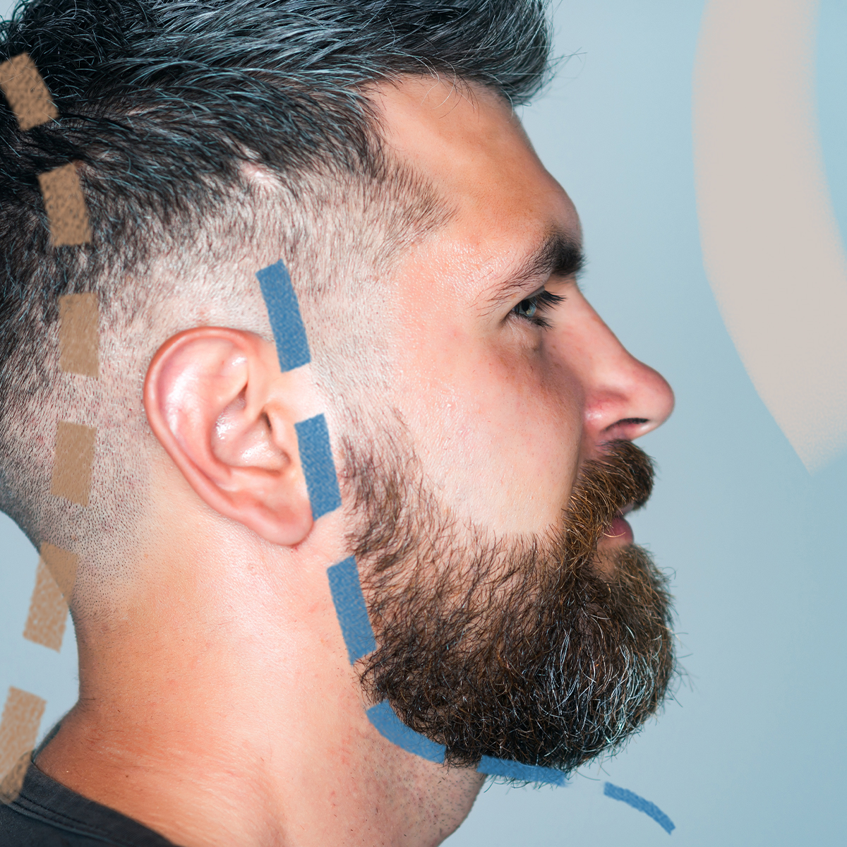 Transplantace vousů Moderní metoda obnovy a zahuštění vousů v Perfect Clinic.