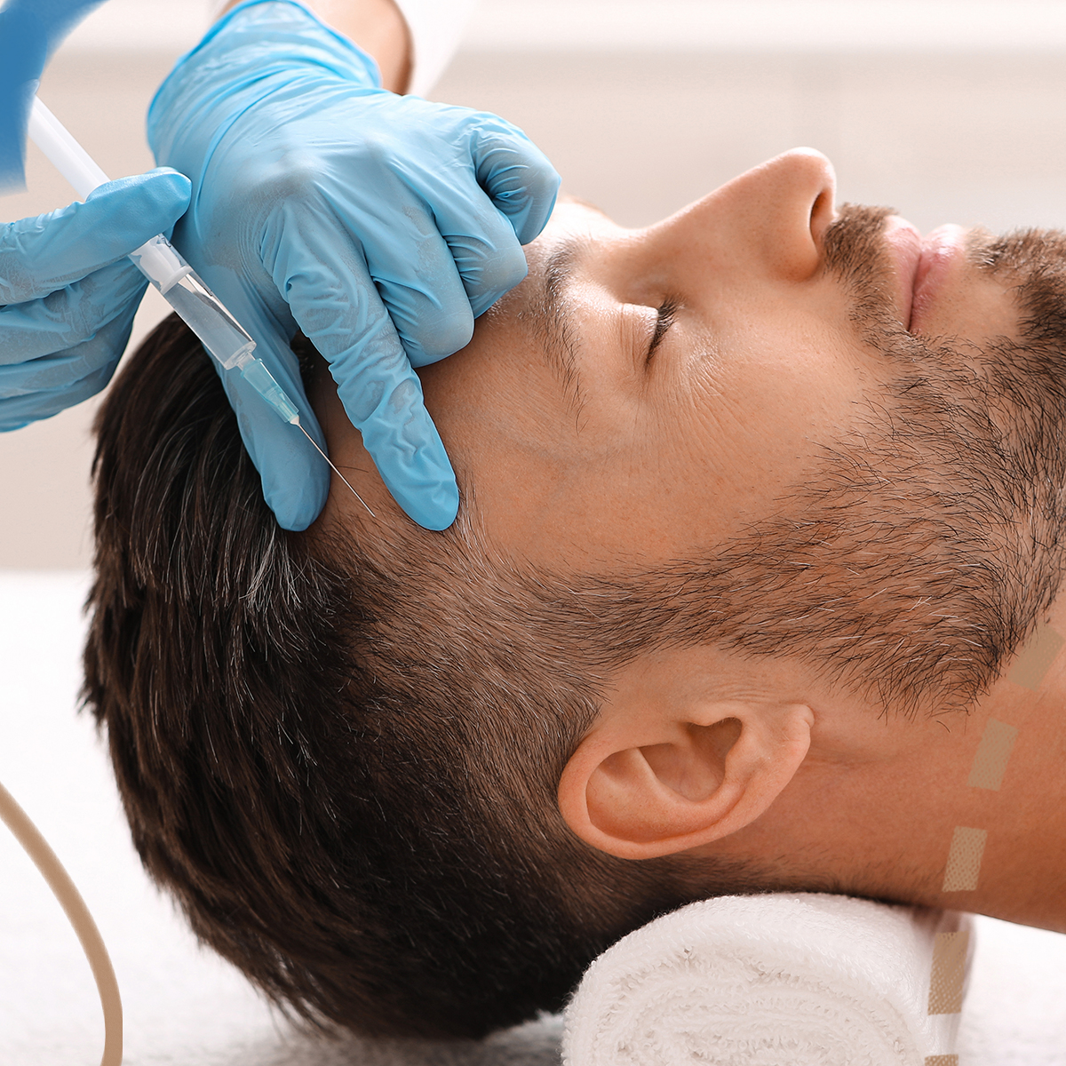 Vlasová mezoterapie