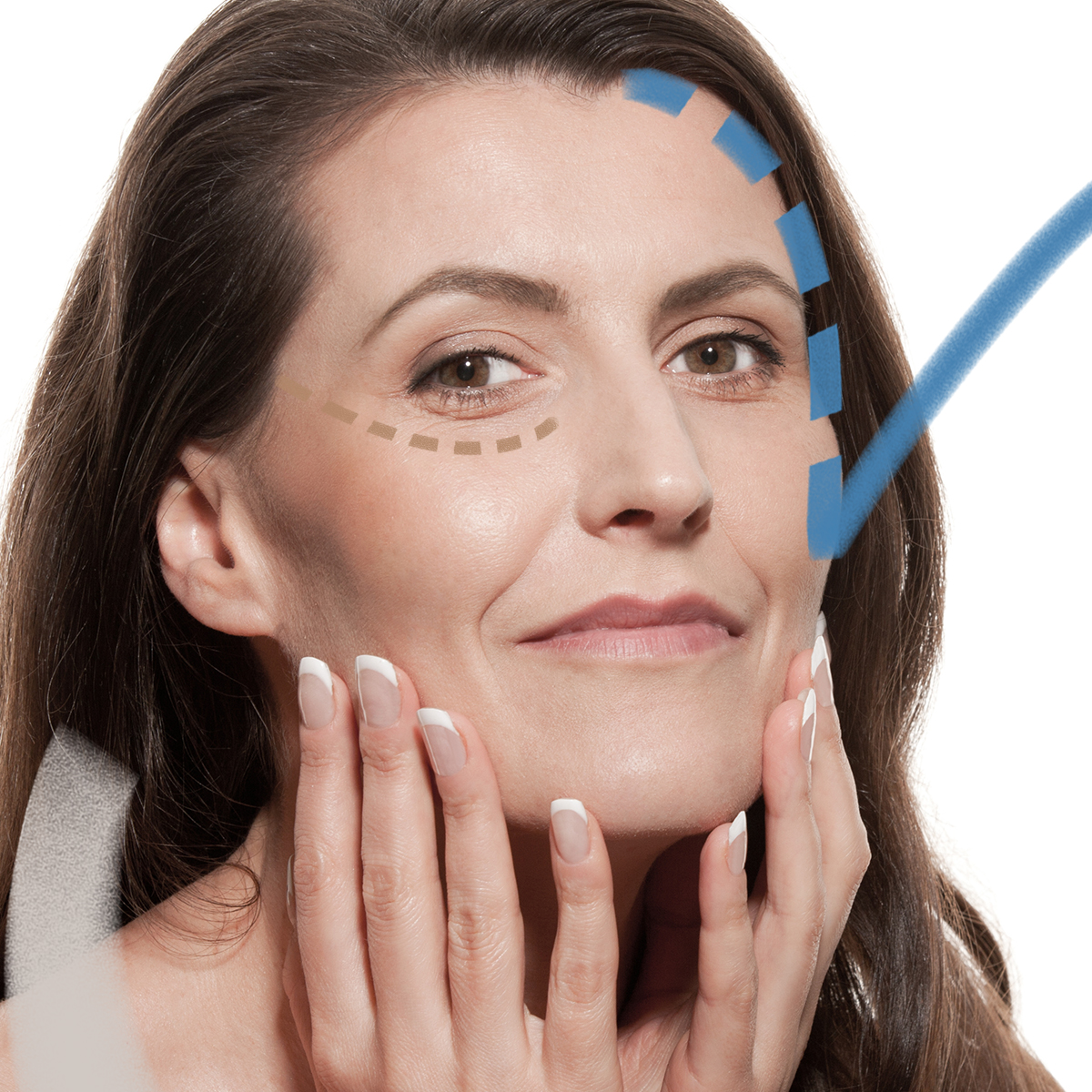 Zvětšení lícních kostí implantátem v Perfect Clinic. Plastická operace zvýrazňující lícní kosti