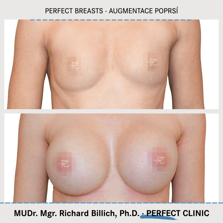 Augmentace poprsí