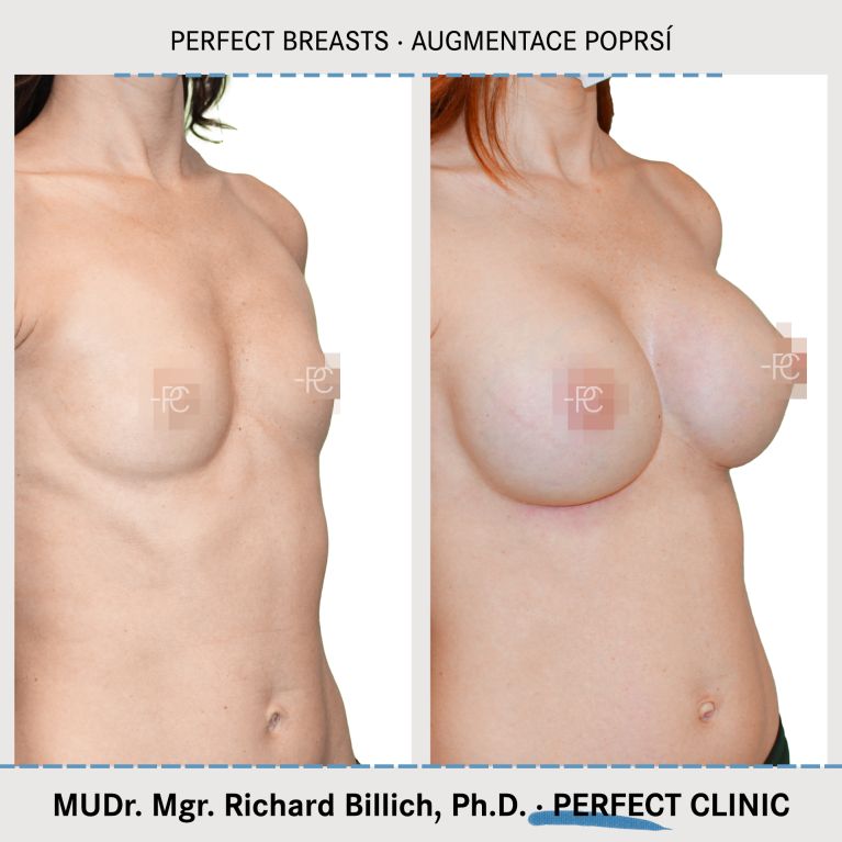 Augmentace poprsí