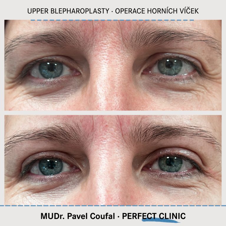 Operace horních víček