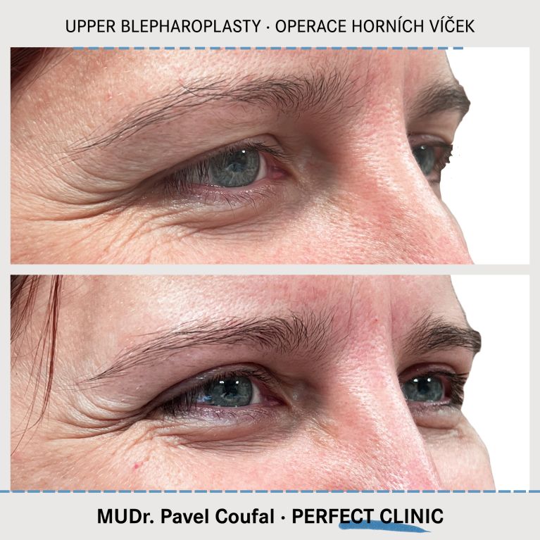 Operace horních víček