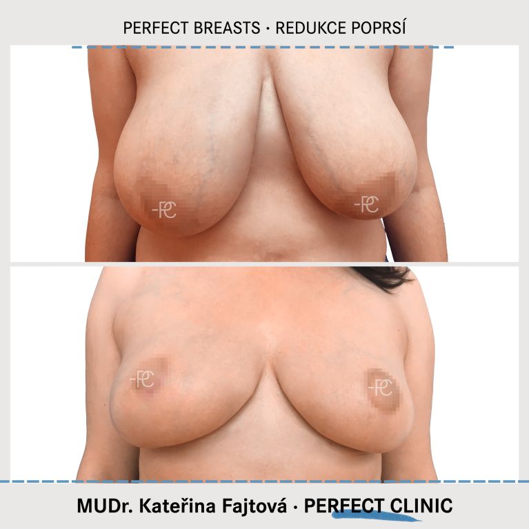 Zmenšení prsou