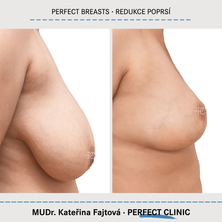 Zmenšení prsou