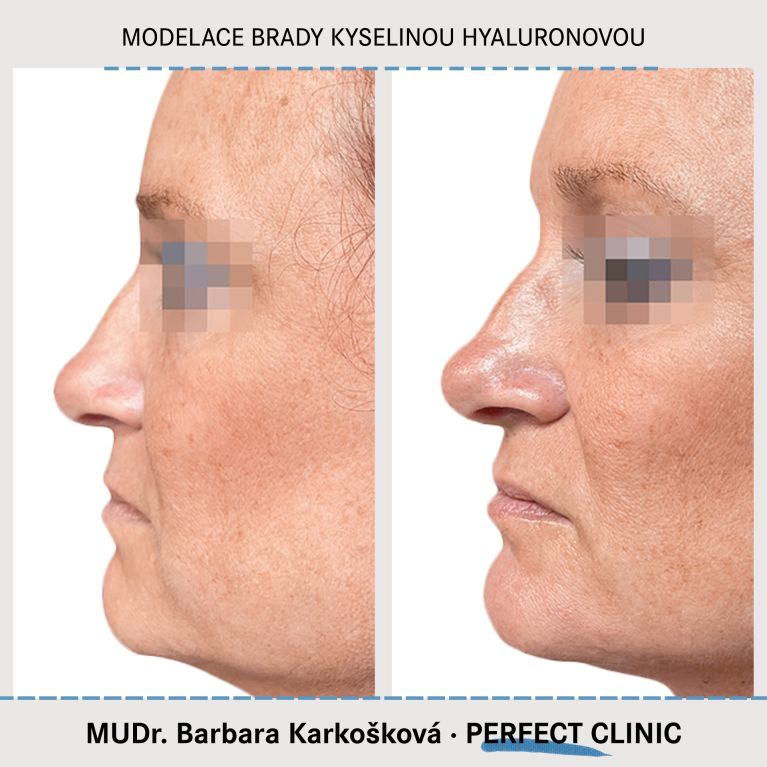Injekční výplně kyselinou hyaluronovou