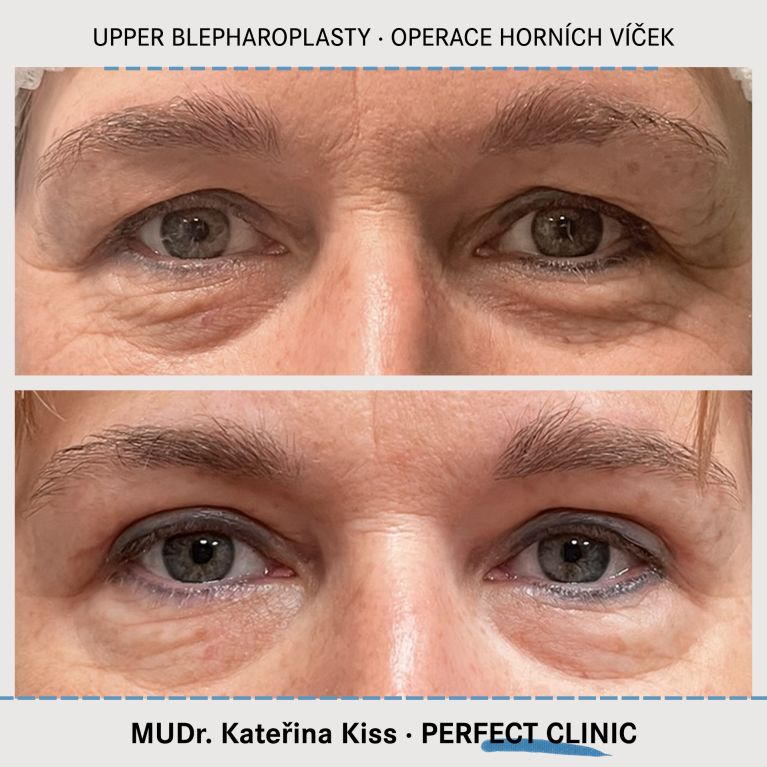 Operace horních víček