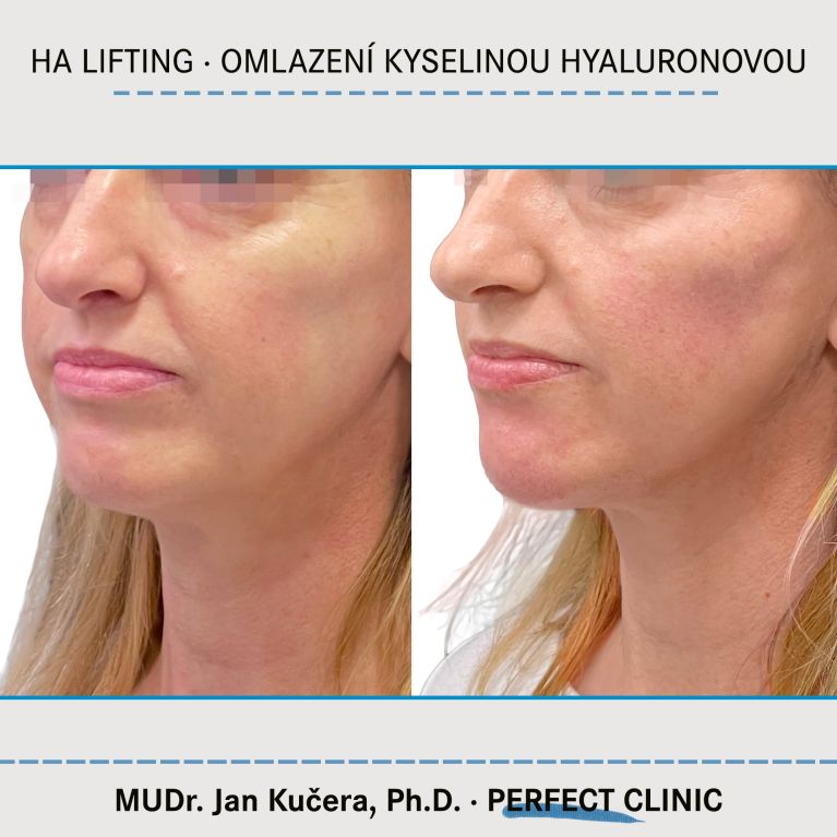 Injekční výplně kyselinou hyaluronovou