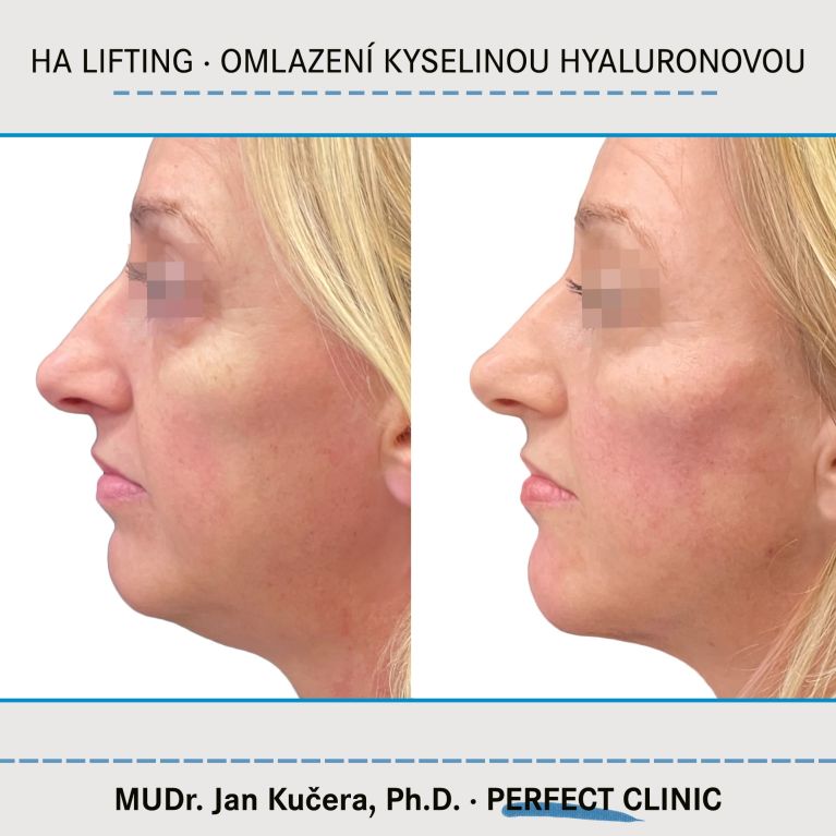 Injekční výplně kyselinou hyaluronovou