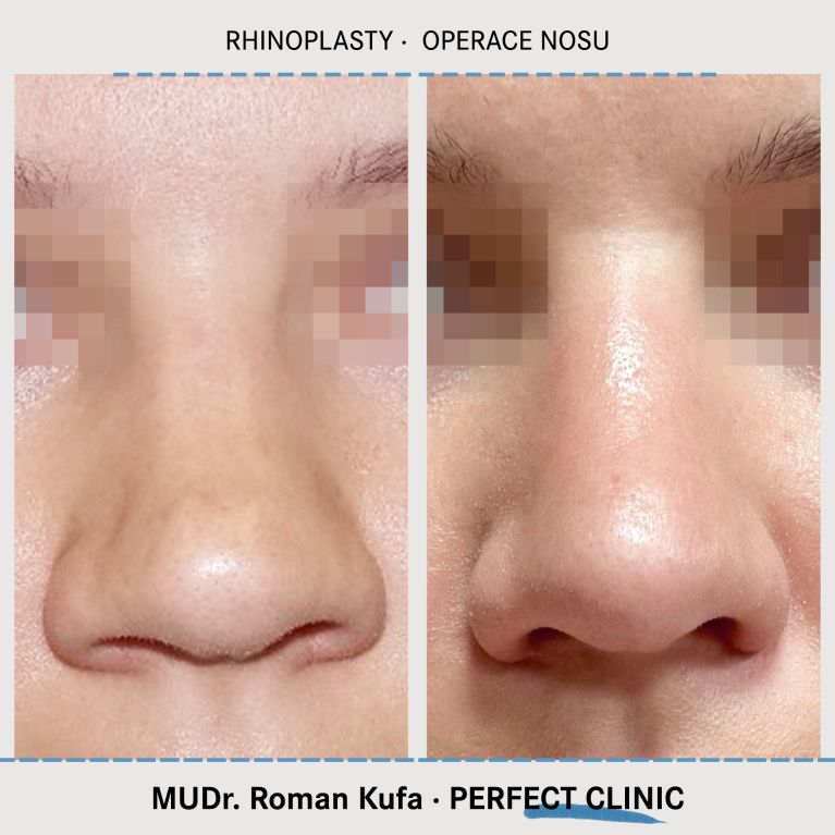 Rhinoplastika