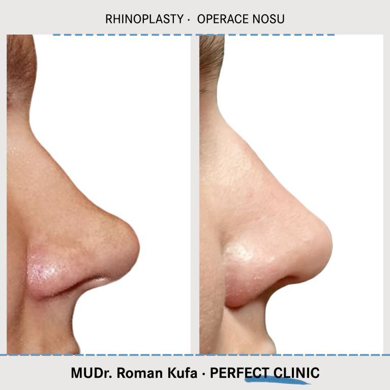 Rhinoplastika