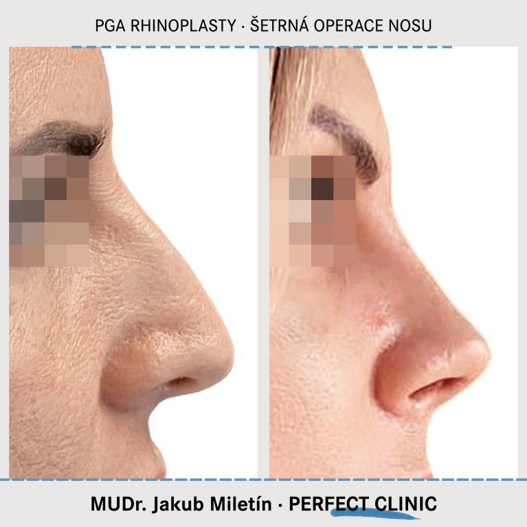 PGA Rhinoplasty