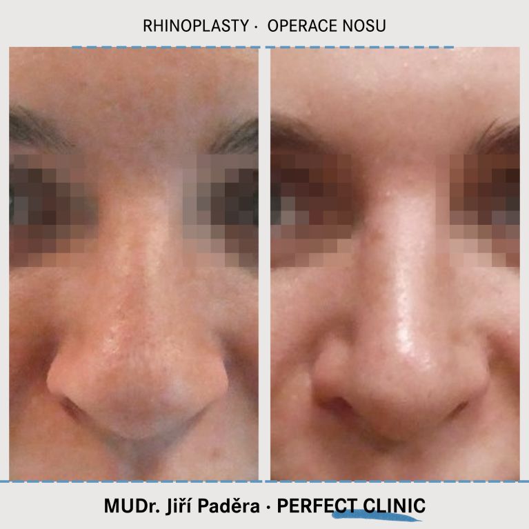 Rhinoplastika
