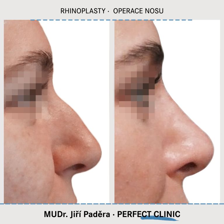 Rhinoplastika