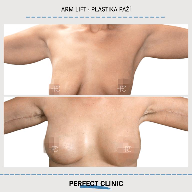 Plastická operace paží