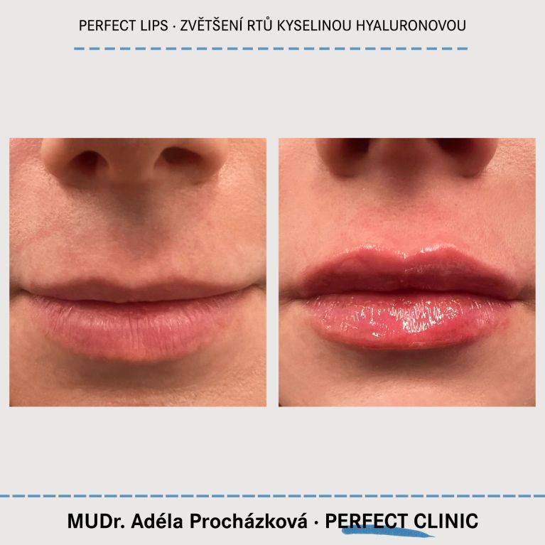 Zvětšení rtů kyselinou hyaluronovou