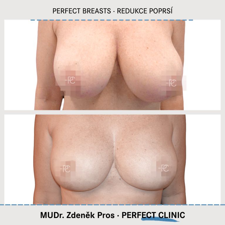 Zmenšení prsou