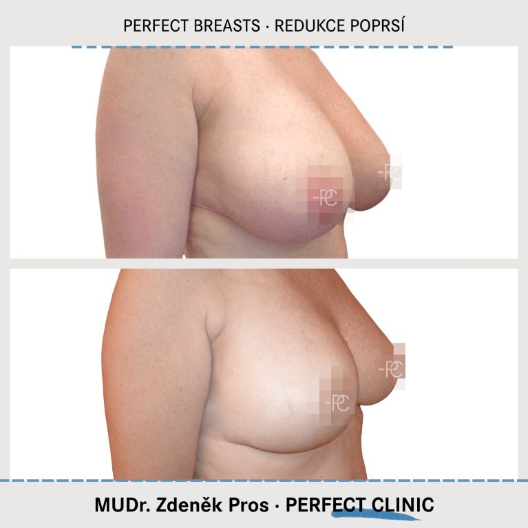 Zmenšení prsou