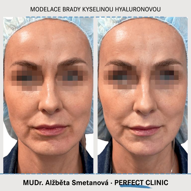 Injekční výplně kyselinou hyaluronovou