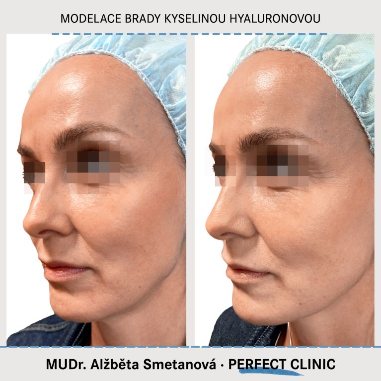 Injekční výplně kyselinou hyaluronovou