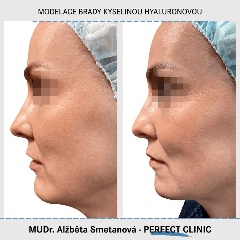 Injekční výplně kyselinou hyaluronovou
