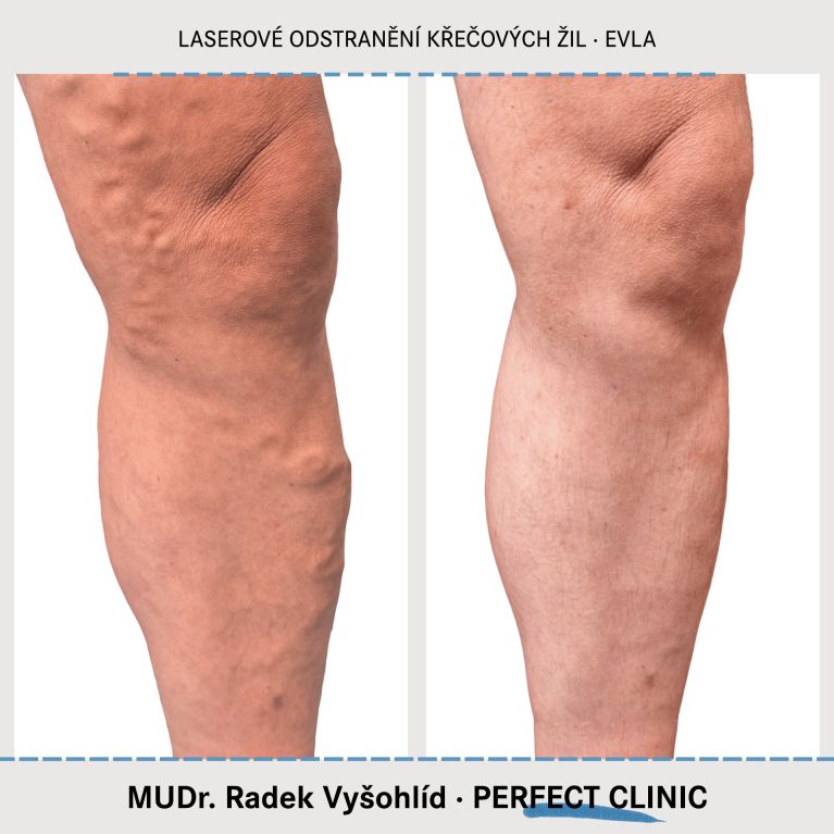 EVLA – Endovenózní laserová ablace