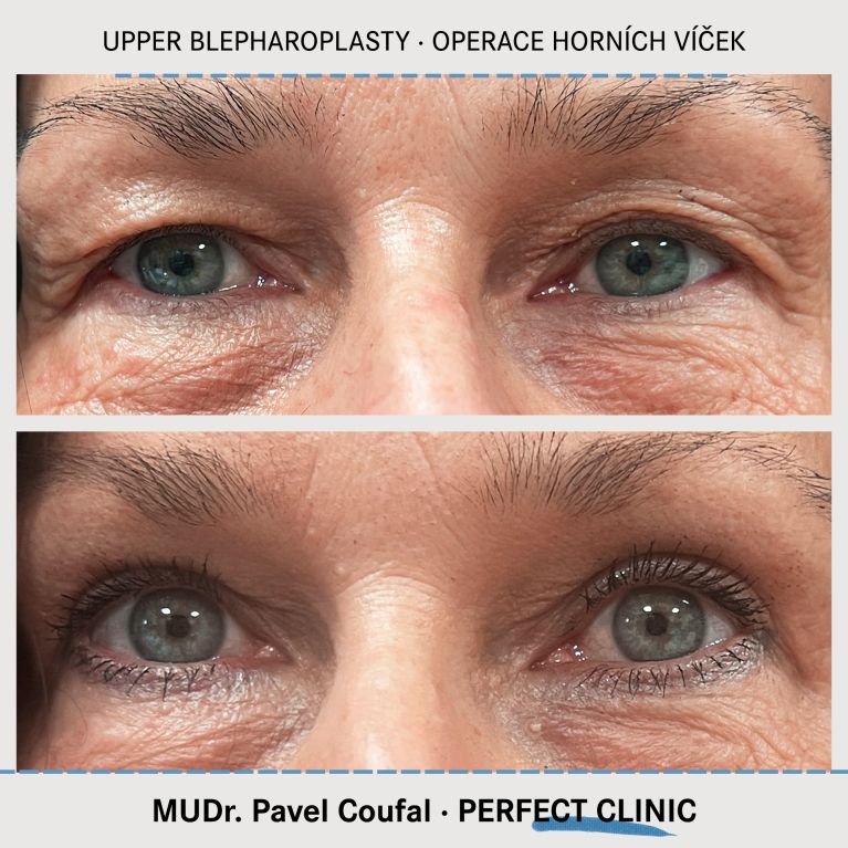 Operace horních víček