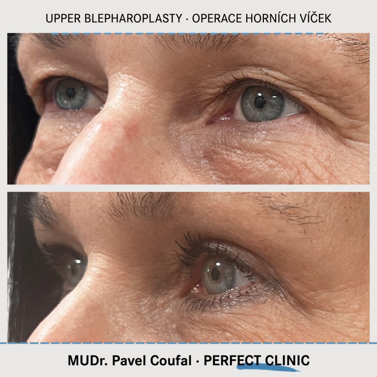 Operace horních víček