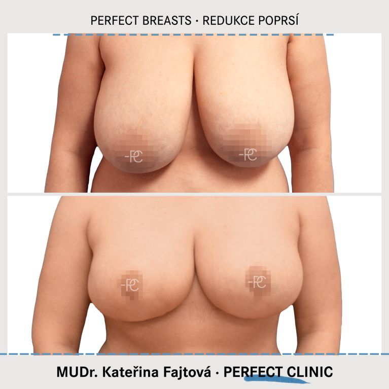 Zmenšení prsou