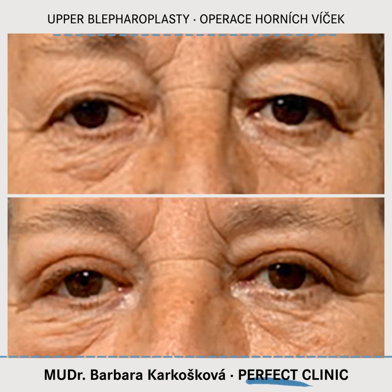 Operace horních víček