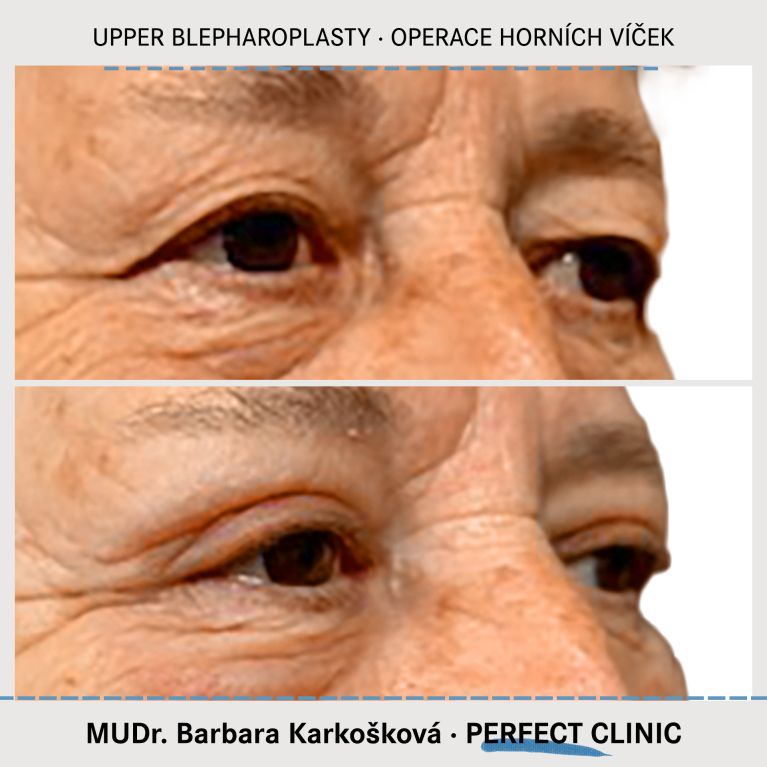 Operace horních víček