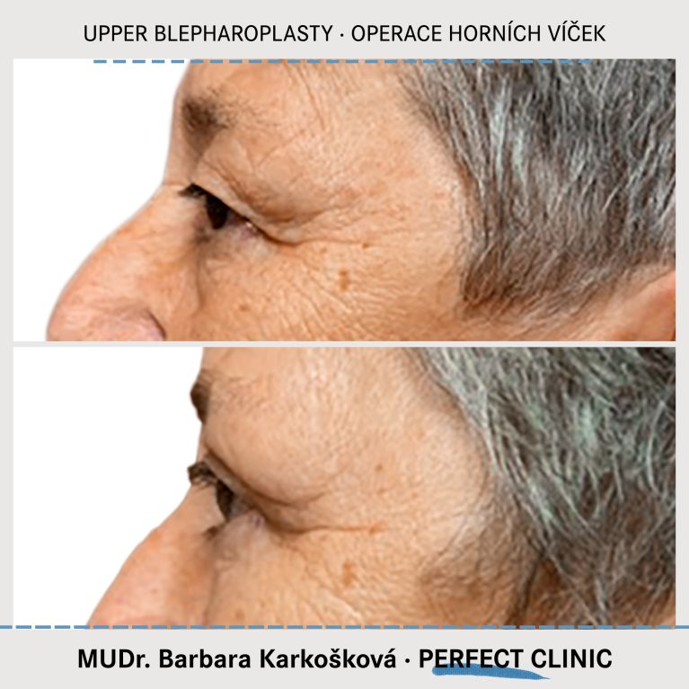 Operace horních víček