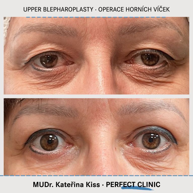 Operace horních víček