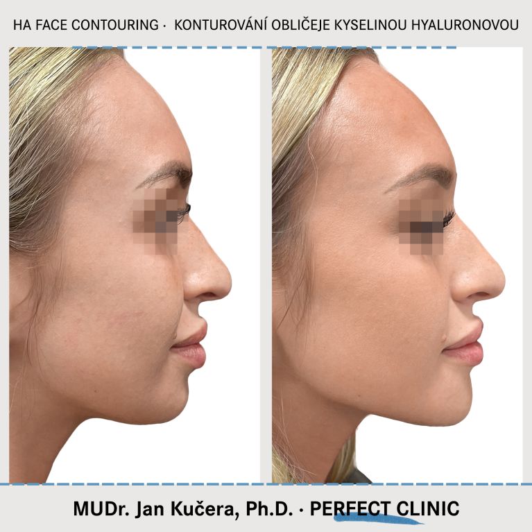 Injekční výplně kyselinou hyaluronovou