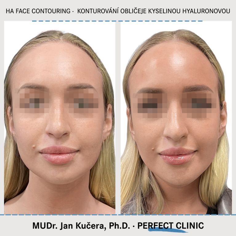 Injekční výplně kyselinou hyaluronovou