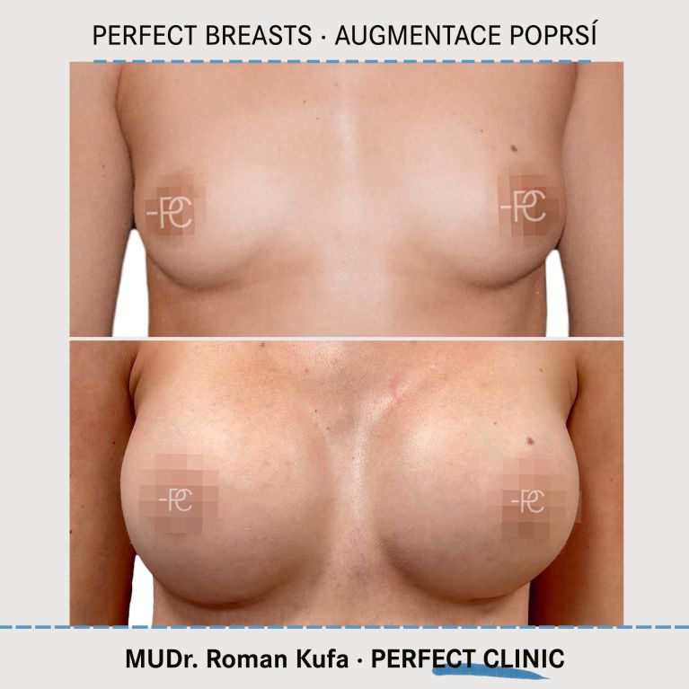 Augmentace poprsí