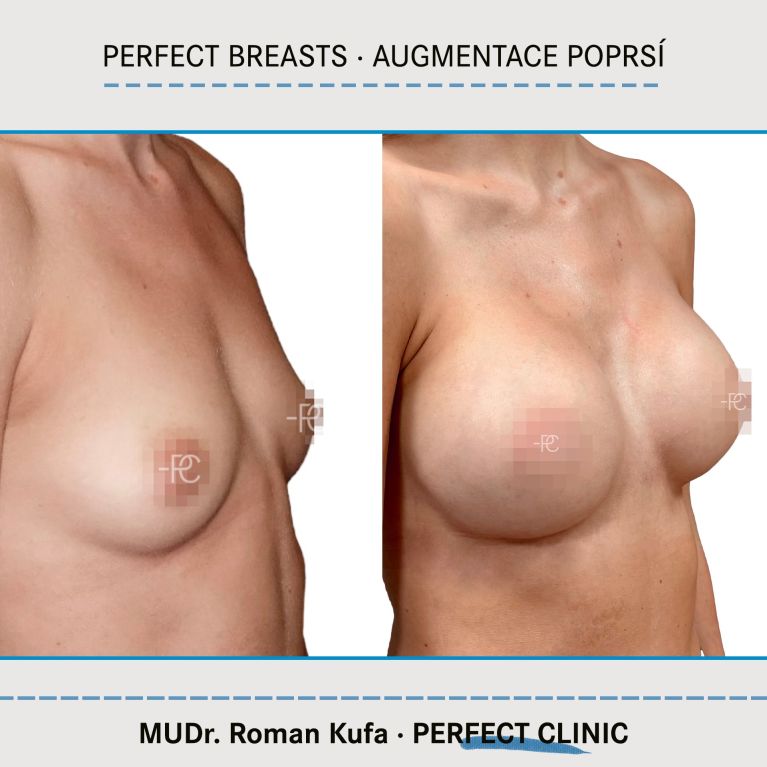 Augmentace poprsí