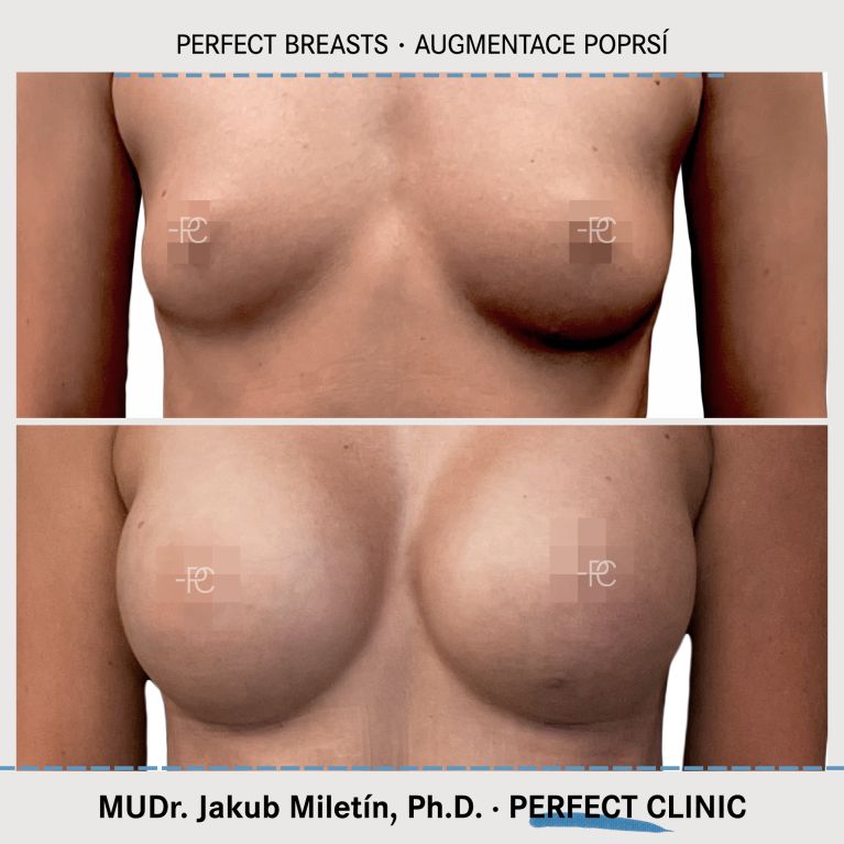 Augmentace poprsí