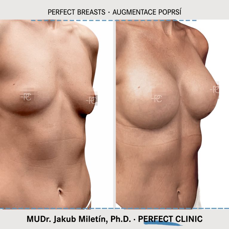 Augmentace poprsí