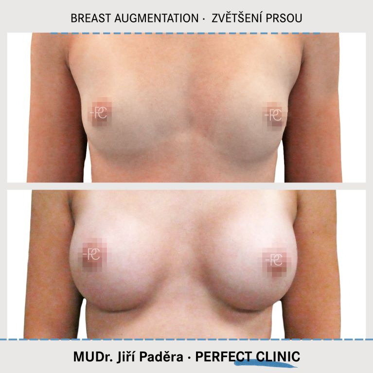 Augmentace poprsí