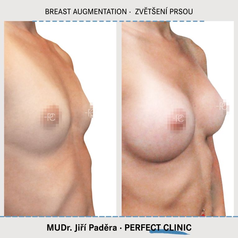 Augmentace poprsí