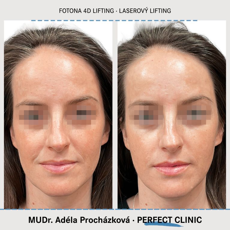 Laserový lifting FOTONA