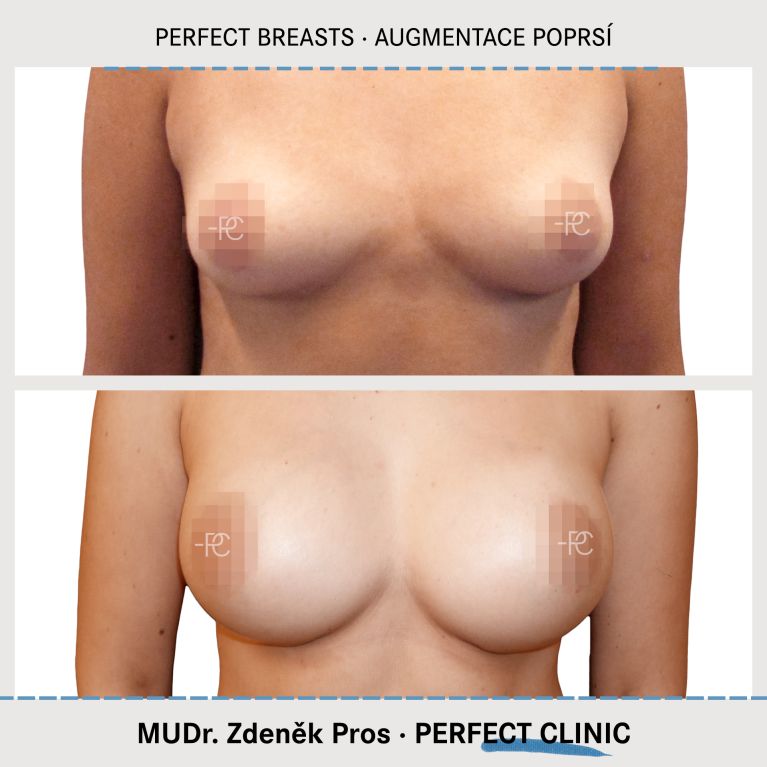 Augmentace poprsí