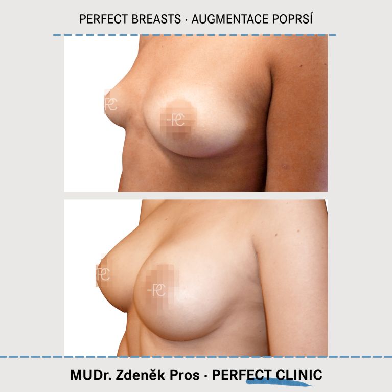 Augmentace poprsí