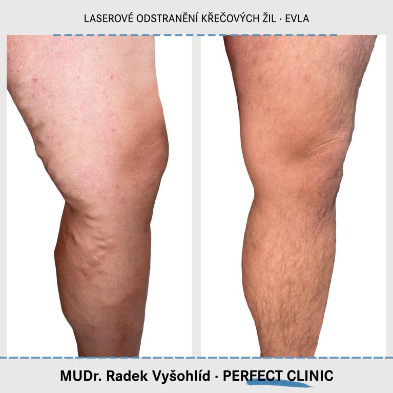 EVLA – Endovenózní laserová ablace