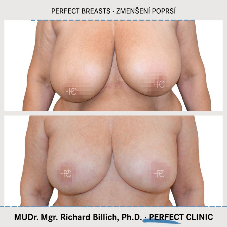 Zmenšení prsou